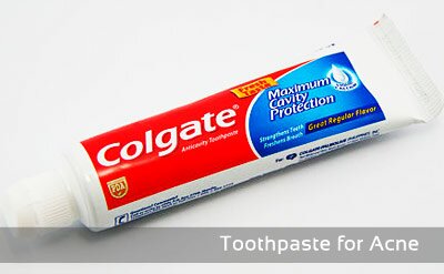 Toothpaste for Acne