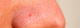 Nose_acne_causes